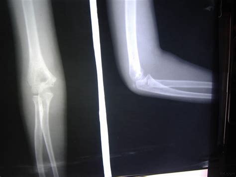 7岁小女孩肘关节后脱位，肱骨内上髁骨骺分离，复位后带图片 - 骨科与显微外科专业讨论版 - 爱爱医医学论坛