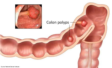 Colonoscopy Polyps Biopsy