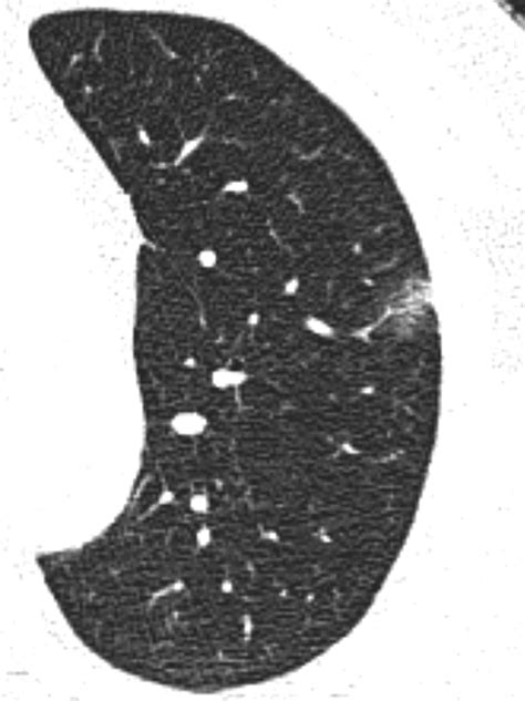 Ground-Glass Nodules on Chest CT as Imaging Biomarkers in the Management of Lung Adenocarcinoma ...