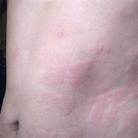 Rash On Skin Itchy