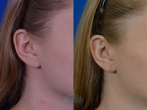 Earlobe Repair Before and After Pictures Case 82 | Charlotte, NC | Dilworth Facial Plastic Surgery