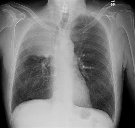 Findings Lungs Atelectasis General | The Common Vein