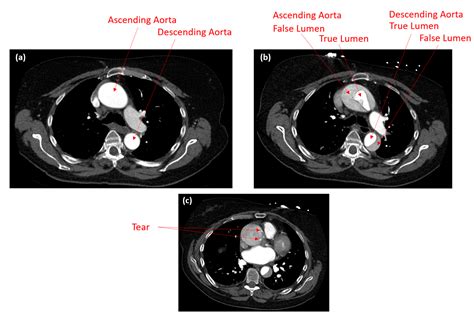 Investigation of Type A Aortic Dissection Using Computational Modelling