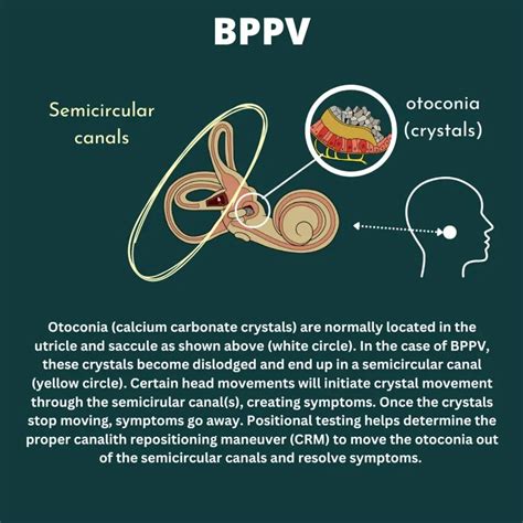 Calcium Crystals In Human Ears 18 Vertigo Inner Ear Crystal Images,
