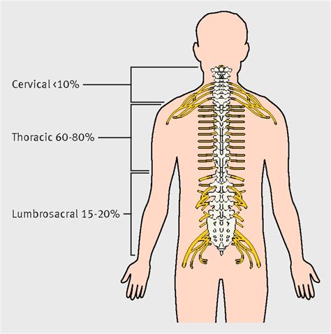 Spinal Cord Compression 的图像结果