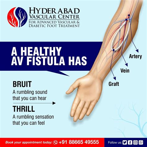 What Is Av Fistula For Dialysis at Harold Raines blog