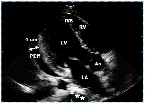 Echocardiography and Newer Imaging Techniques in Diagnosis and Long ...