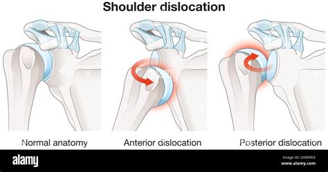 Shoulder Dislocation Contortion 的图像结果