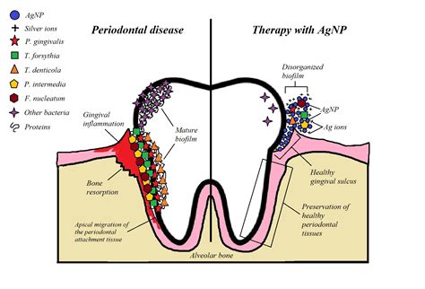 Bactericidal Activity of Silver Nanoparticles on Oral Biofilms Related to Patients with and ...