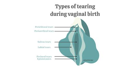 Different Types of Tearing That May Occur During Childbirth — Lady Bird PT