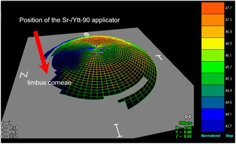 Changes of Corneal Biomechanical Properties upon Exclusive Ytt-/Sr-90 ...