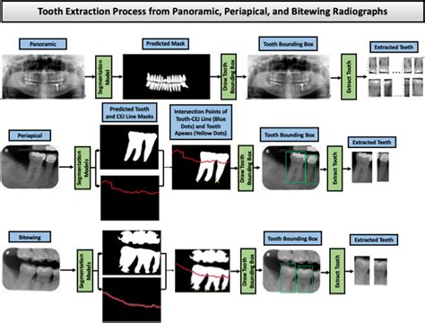 Image result for Tooth Extraction Side Profile