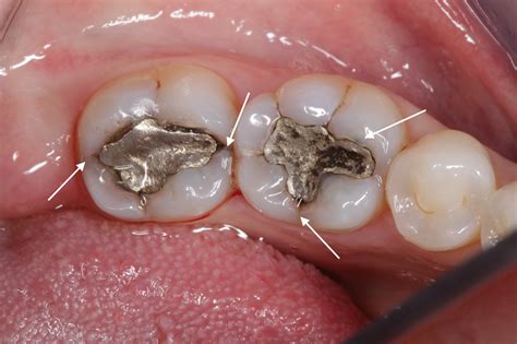 The problem with large metal (amalgam) fillings — Nova Smiles