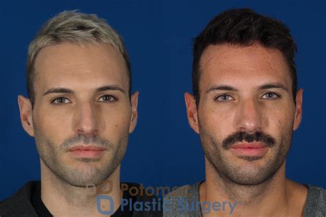 Deviated Septum Before And After