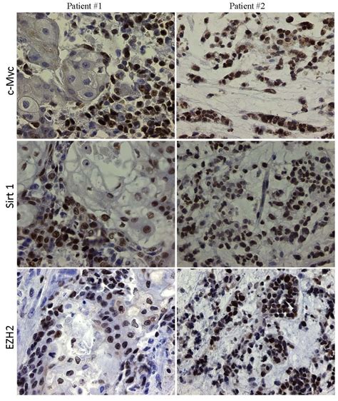 NUT Midline Carcinoma: Morphoproteomic Characterization with Genomic and Therapeutic Correlates