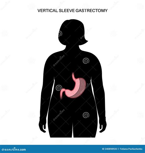 Laparoscopic Sleeve Gastrectomy Stock Vector - Illustration of sleeve, care: 240898920