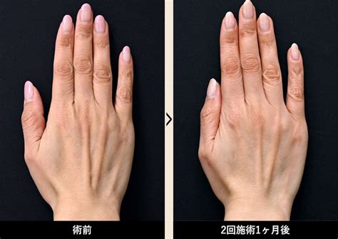 プロファイロ（ヒアルロン酸）｜若返り・エイジングケアなら湘南美容クリニック【公式】