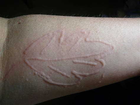 Are there any good treatments for skin writing disease? : r/urticaria