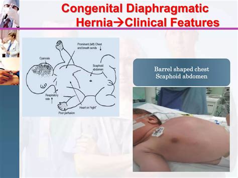 Congenital diaphragmatic hernia / Pediatric surgery | PPT