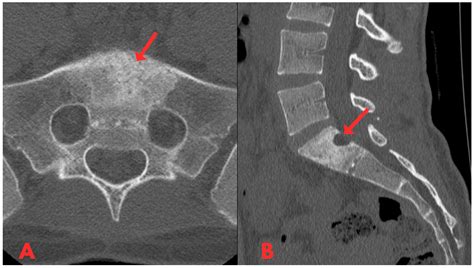 Benign Notochordal Cell Tumours: Case Report and Literature Review