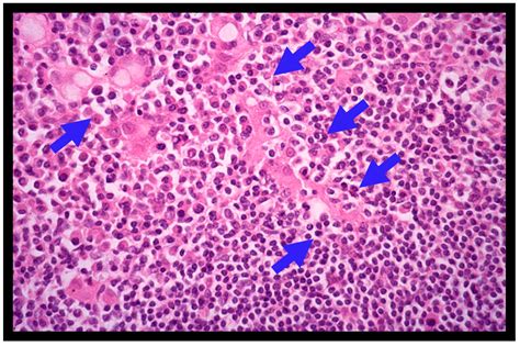 Diagnosis and Treatment for Gastric Mucosa-Associated Lymphoid Tissue ...