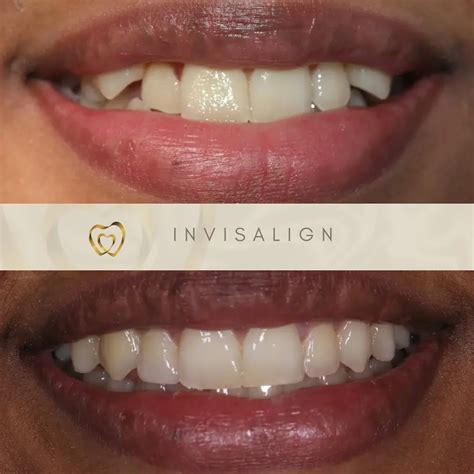 Invisalign Before and After - Before After Journey