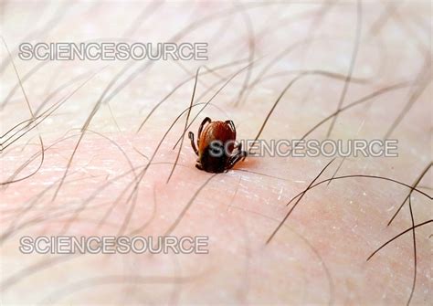 Image result for Embedded Deer Tick