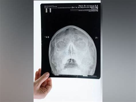 Study: Risk of skull fractures is higher in men than women