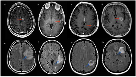 Brain Functional Connectivity in Low- and High-Grade Gliomas ...