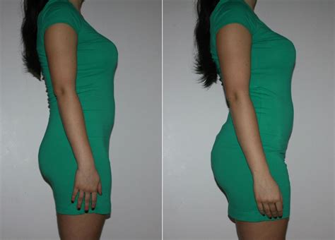 Is A Brazilian Butt Lift Surgery Right For You Requirements For Bbl Surgery – Access High ...