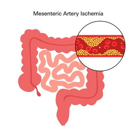 Atherosclerosis: Causes, Risk Factors and Treatments