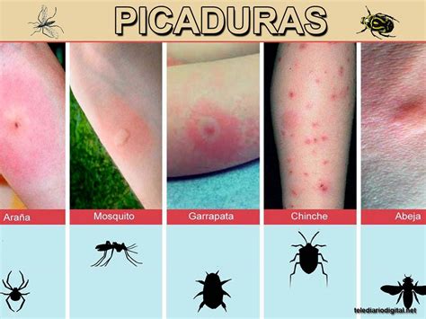 Picaduras De Insectos Infectadas Que Hacer – EHTN