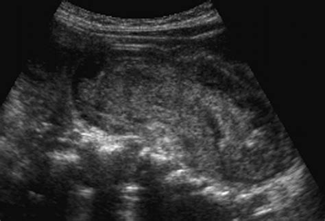 Intussusception Ultrasound Intussusception || Ultrasound || Case 154