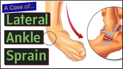 Lateral Ankle Sprain - MedEd Cases