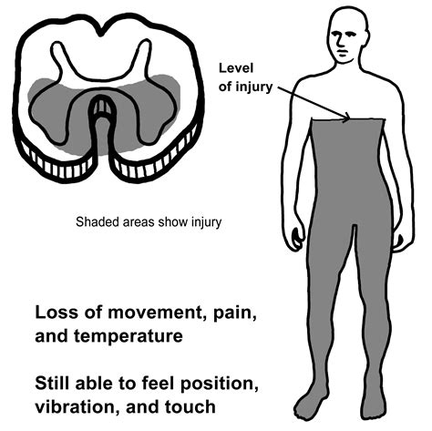 Anterior Cord Syndrome Symptoms