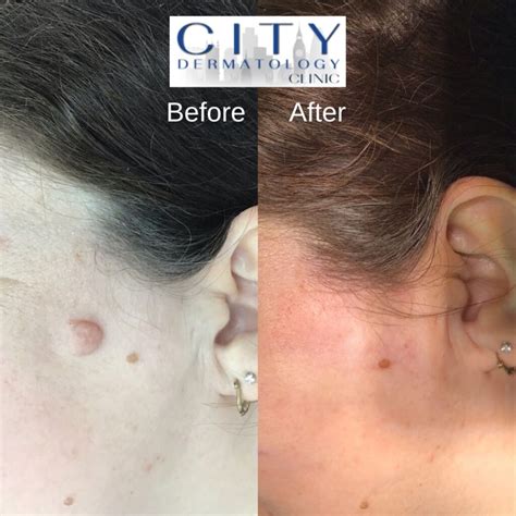Before & After Photos Mole Removals