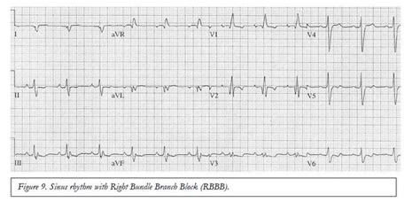 Image result for Normal vs Abnormal ECG