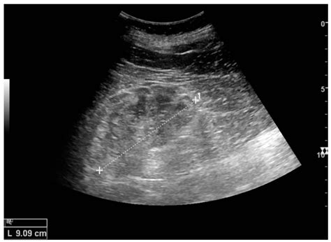 Ultrasonography of the Kidney: A Pictorial Review