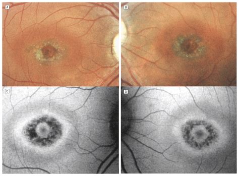 Bull's Eye Maculopathy
