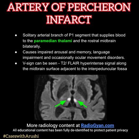 Artery of Percheron Infarct - radiology student - radiology aesthetic in 2025 | Radiology ...