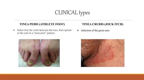 Dermatophytes | PPTX