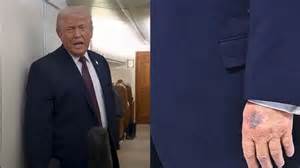 Donald Trump's Bruised Hand Catches Everyone's Eye At Davos Summit ...