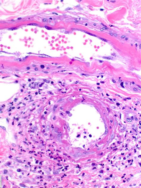 Vasculitis Histology Cutaneous Vasculitis Diagnostic Histopathology