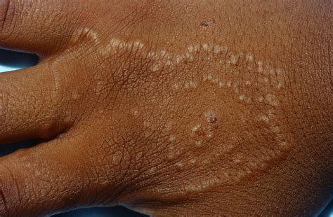 Granuloma Annulare - Causes, Rash, Treatment