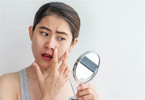 What Is Stress Acne: Causes, Treatment, Prevention