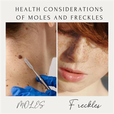 Moles Vs. Freckles: Expert Insights on Skin Mark Identification ...