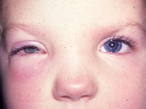 Make the Diagnosis: A Toddler with Swollen Eyelids - MedPage Today