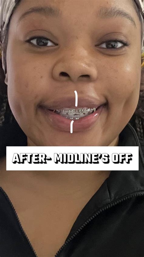 Jaw surgery ruined my face (before/after) : r/jawsurgery