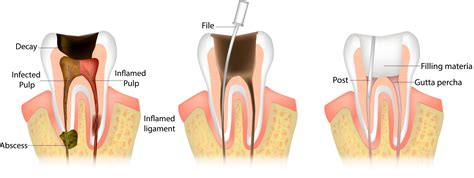 What Is An Endodontics at Michelle Peckham blog