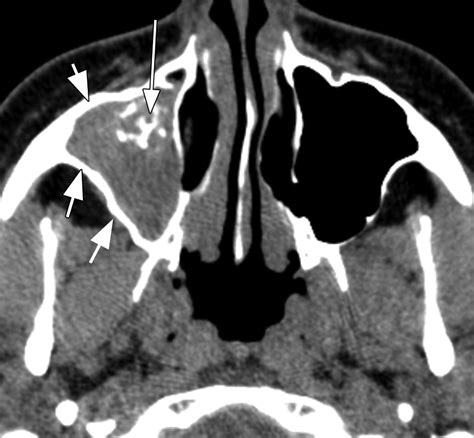 Fungal Ball Sinus Ct Scan at Rosalind Rinaldi blog